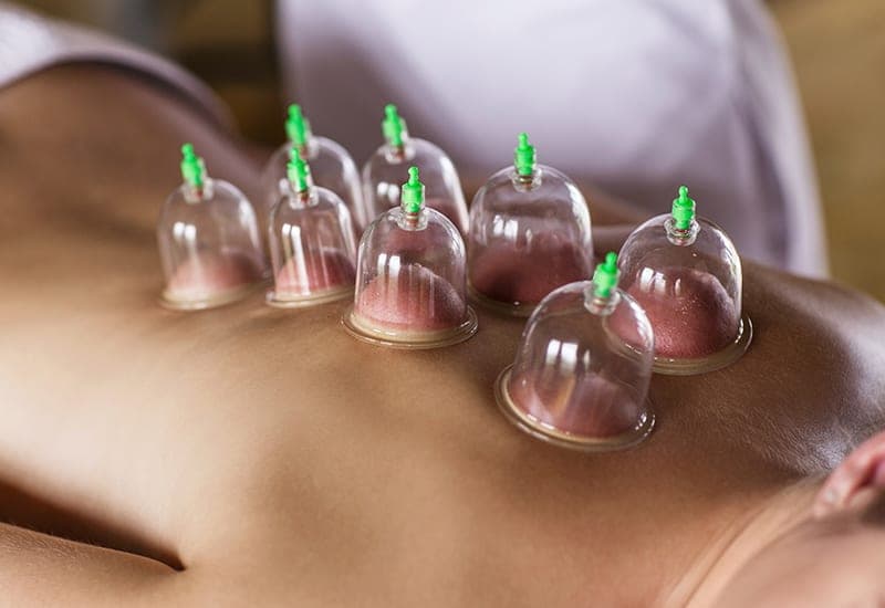 Dry Cupping Therapy